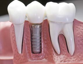 Dental crown on dental implant