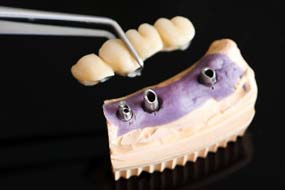 Puente dental sobre implantes dentales