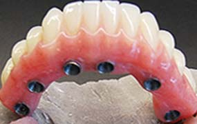 Dental prosthesis complete fixed of bottom on 6 implants denture of bottom fixed on 6 implants