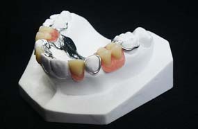 Dental prosthesis partial of top in metal vitallium denture partial